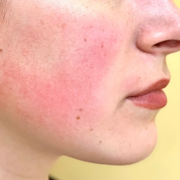 Rosacea-treatments-greater-washington-dc-1030x673_11zon