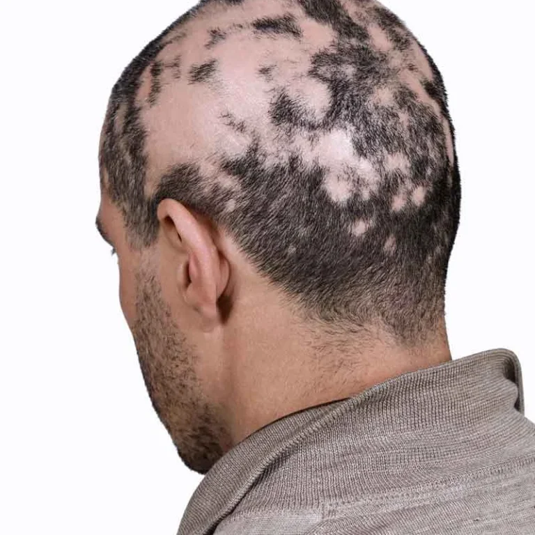 alopecia-areata-izq