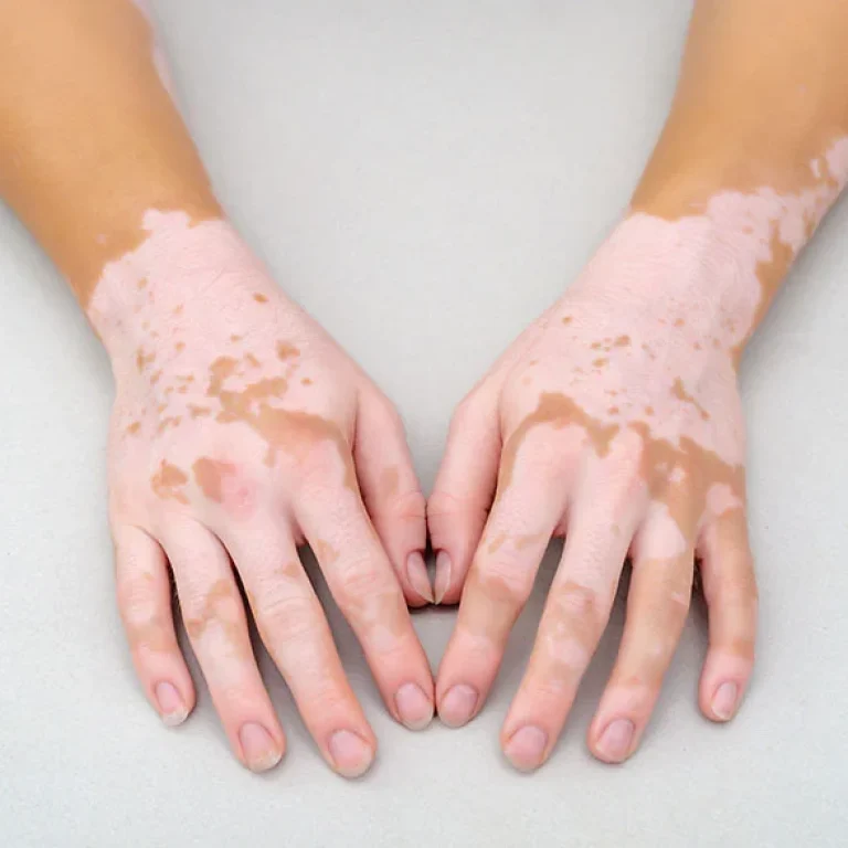 vitiligo-research